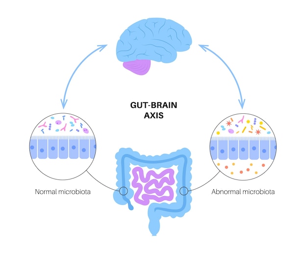 Vecteur dysbiose et microbiome de la connexion intestin-cerveau microbiote normal et anormal