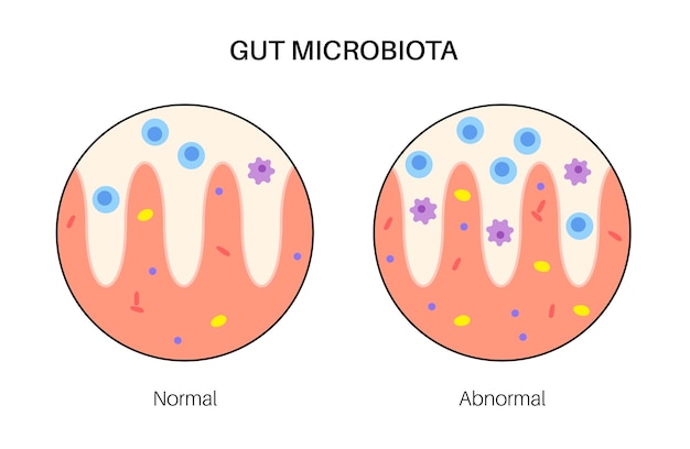 Vecteur dysbiose et microbiome de la connexion intestin-cerveau microbiote normal et anormal