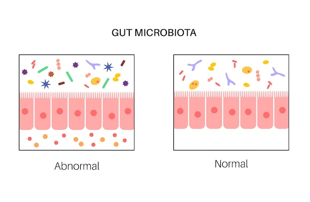 Vecteur dysbiose et microbiome de la connexion intestin-cerveau microbiote normal et anormal