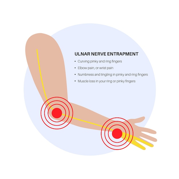 Vecteur emprisonnement du nerf ulnar