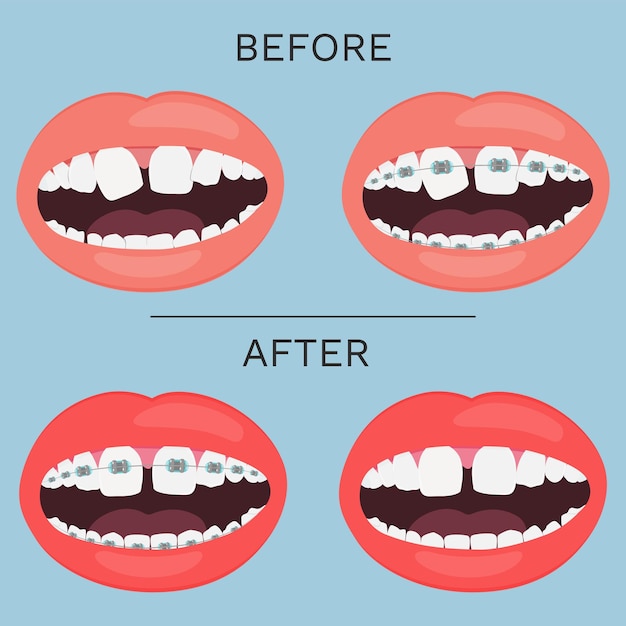 Vecteur un ensemble de dents et d'accolades montrant l'avant et l'après.