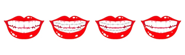 Ensemble De Dessin Animé De Bouches Souriantes Avec étapes D'alignement Des Dents à L'aide D'accolades Métalliques Orthodontiques Sur Fond Blanc