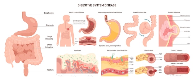 Vecteur ensemble de maladies du système digestif trouble de gastro-entérologie interne