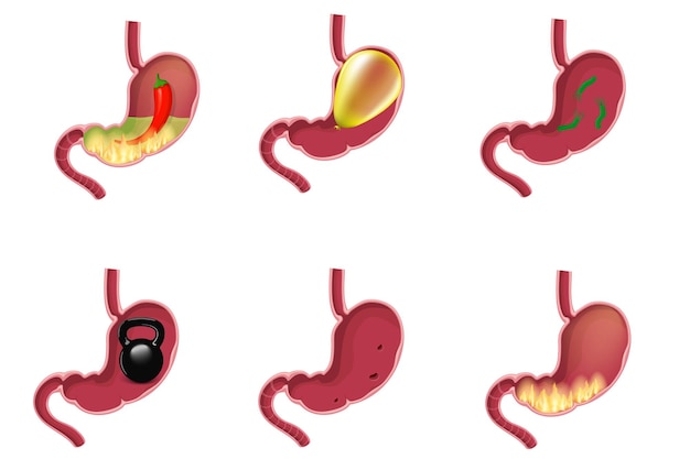 Vecteur ensemble de maladies de l'estomac
