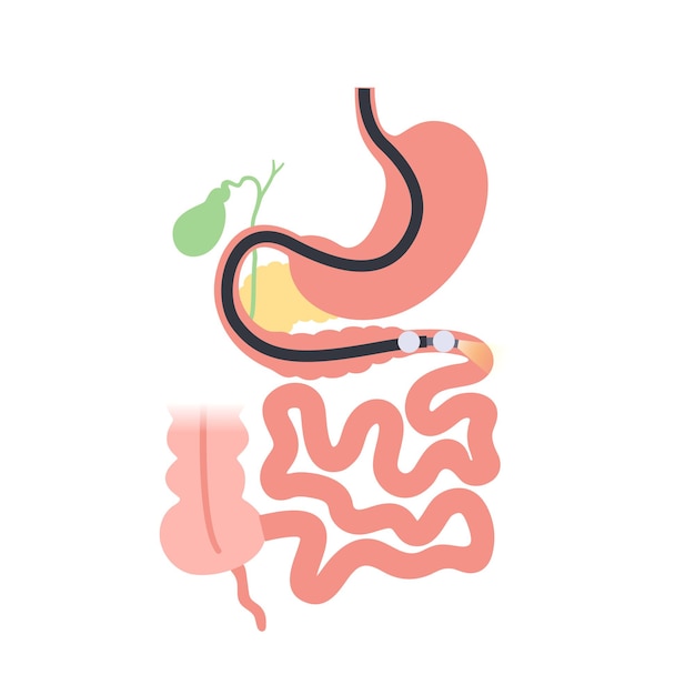 Vecteur entéroscopie assistée par ballon visualisation de la procédure non chirurgicale de l'intestin grêle examen du tractus gastro-intestinal biopsie élimination des polypes thérapie hémorragique ou illustration vectorielle de placement de stent