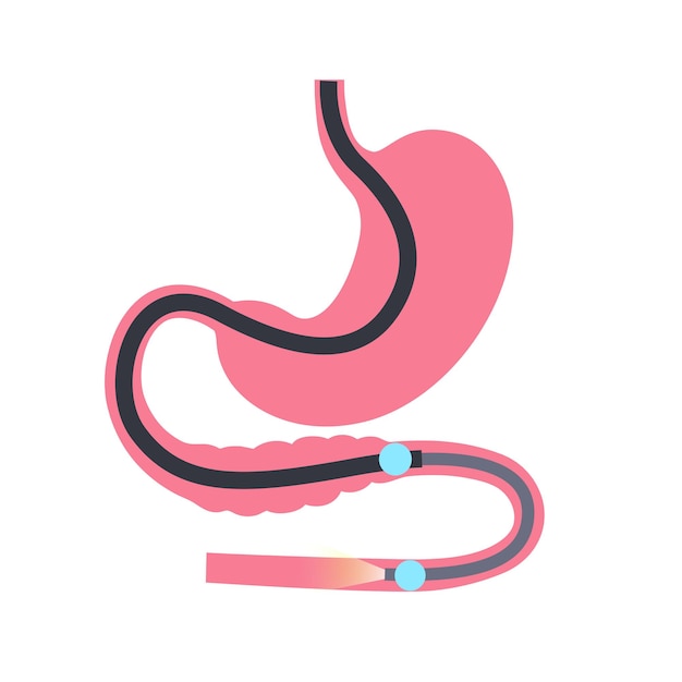 Entéroscopie à Double Ballonnet Procédure Mini-invasive Visualisation De L'intestin Grêle Biopsie élimination Des Polypes Thérapie Hémorragique Placement Du Stent Dans L'illustration Vectorielle Du Tractus Gastro-intestinal