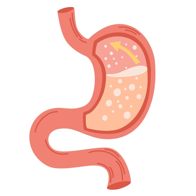 Vecteur estomac humain concept de maladie de reflux gastro-oesophagien concept d'estomac malsain maladie de brûlures d'estomac malaise douleur illustration vectorielle plane isolée sur blanc