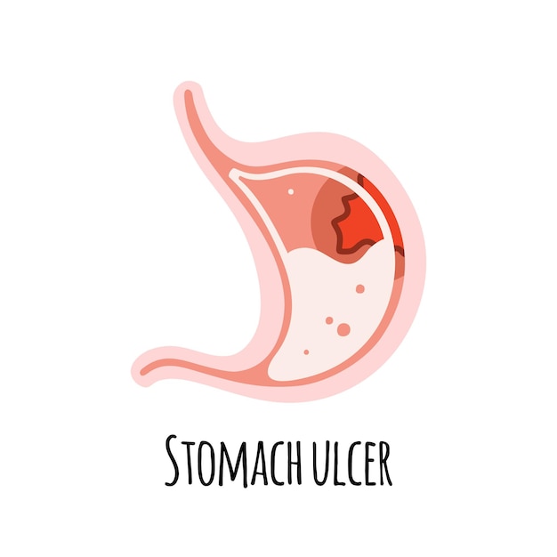 L'estomac d'une personne atteinte d'un ulcère Gastroentérologie Illustration vectorielle dans un appartement