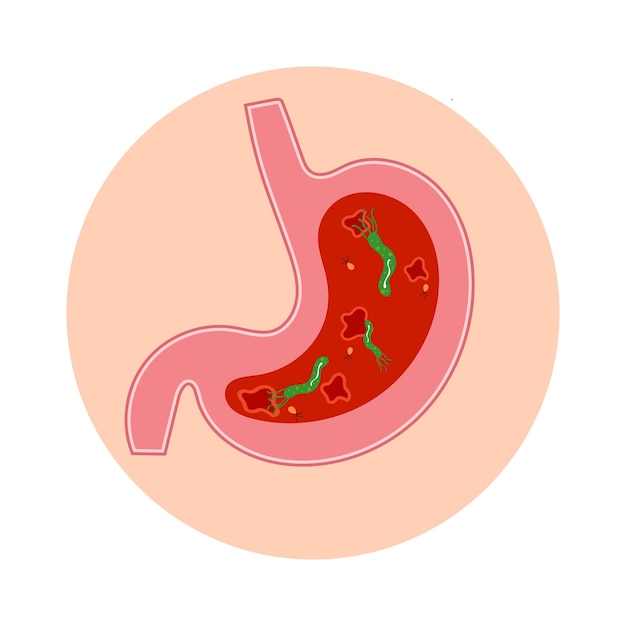 Estomac Avec Ulcères Helicobacter Pylori Et Bactéries à L'intérieur