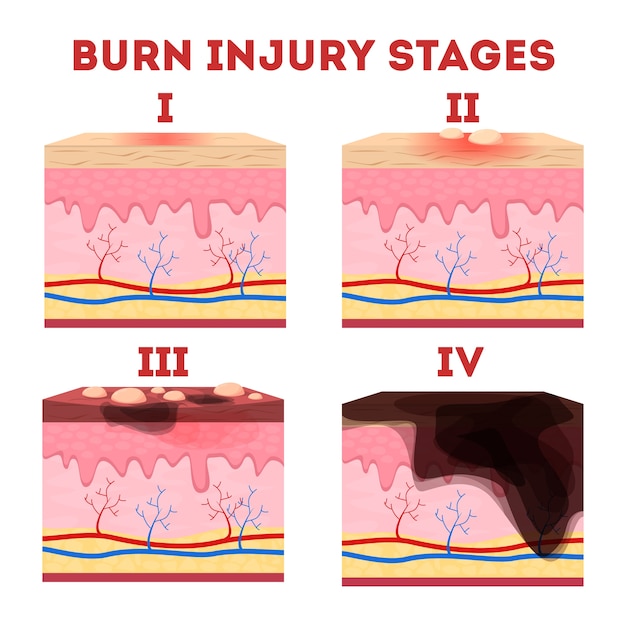 Étapes Des Brûlures Cutanées. Anatomie De La Peau.