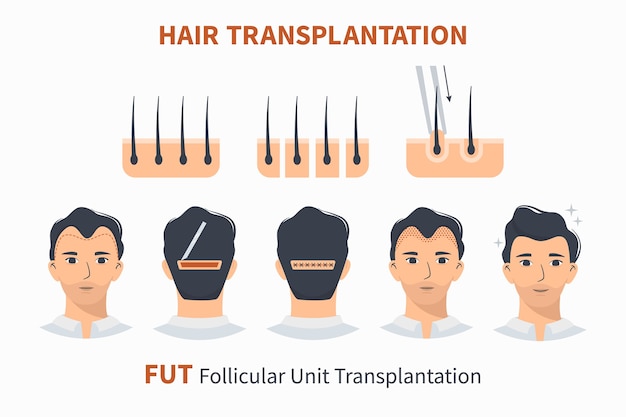 Étapes De La Greffe De Cheveux Unité Folliculaire Fut