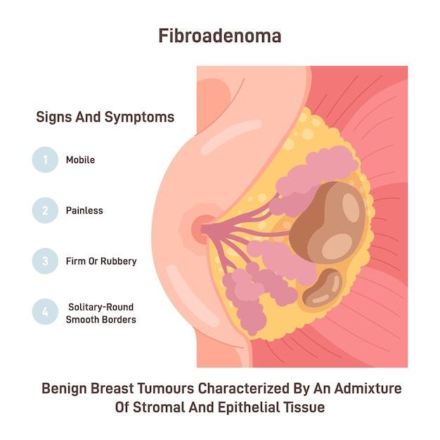 Fibroadénome Tumeur du thorax chez la femme Tumeur bénigne du sein