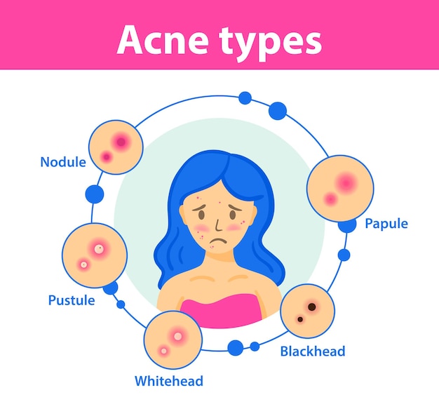 Fille Triste Avec De L'acné Sur Le Visage Types D'acné