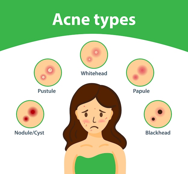 Fille Triste Avec De L'acné Sur Le Visage Types D'acné