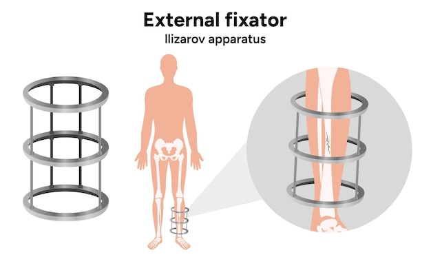 Vecteur fixateur externe appareil de zoom llizarov