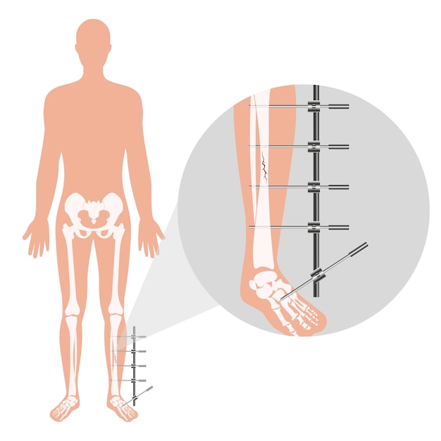 Vecteur fixateur externe appareil de zoom llizarov