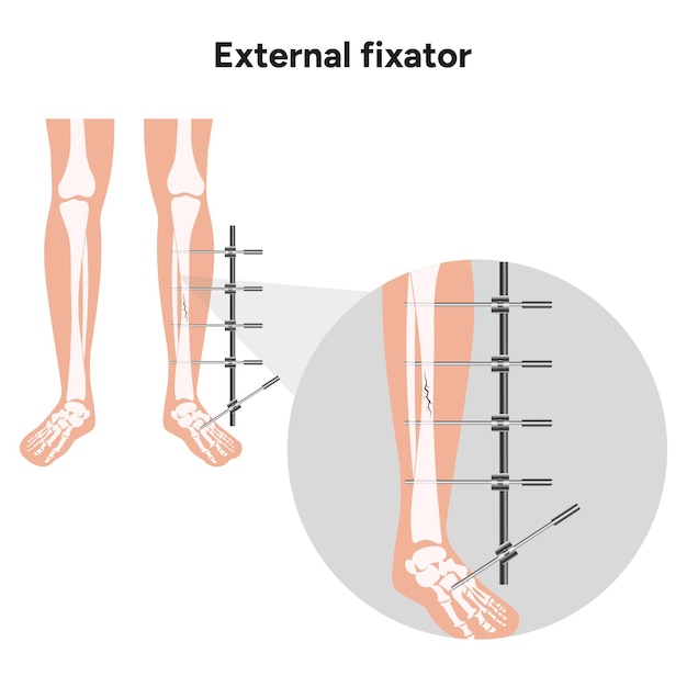 Vecteur fixateur externe appareil de zoom llizarov