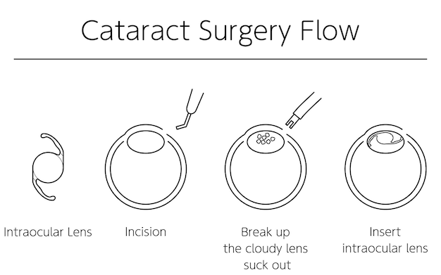 Vecteur flux de chirurgie de la cataracte illustration illustrée dessin au trait