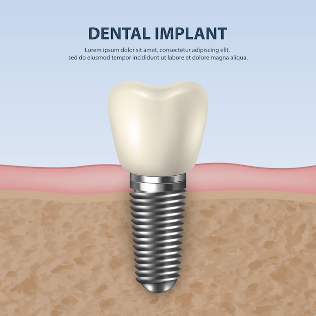 Fond de vecteur avec rendu 3d réaliste Implant de dent blanche Prothèse agrandie Médecine dentaire et modèle de conception de concept de santé de la structure de la prothèse Vue de face