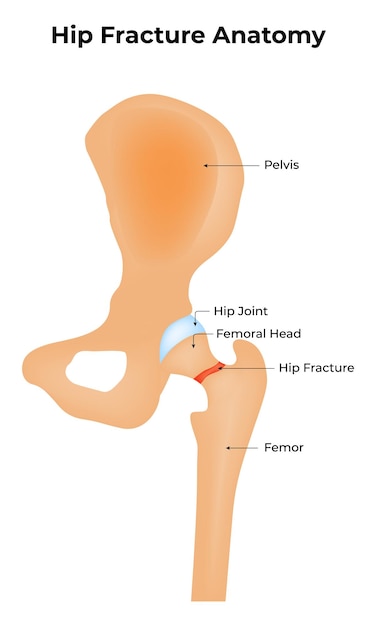 Fracture de la hanche Anatomie du bassin Jointe de la Hanche Tête fémorale Illustration vectorielle de la fracture de la hanse et du fémur