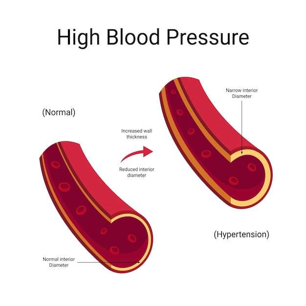 Vecteur hypertension artérielle illustration vectorielle hypertension infographique