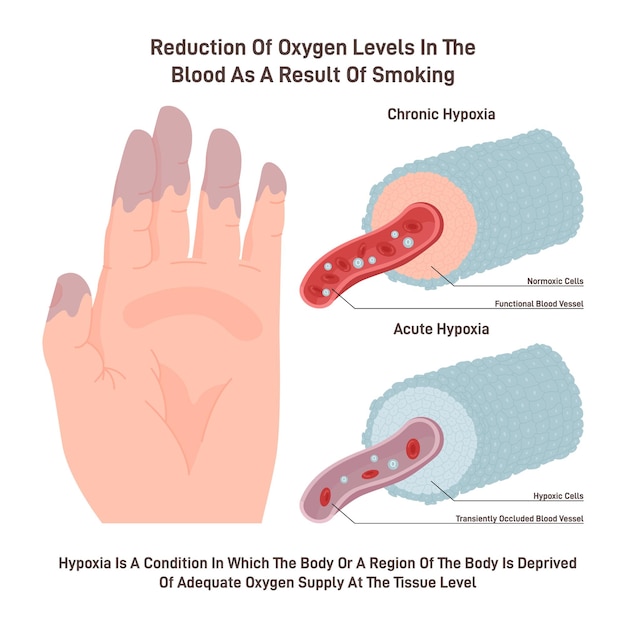 Vecteur hypoxie chronique effet dangereux du tabagisme sur l'apport d'oxygène