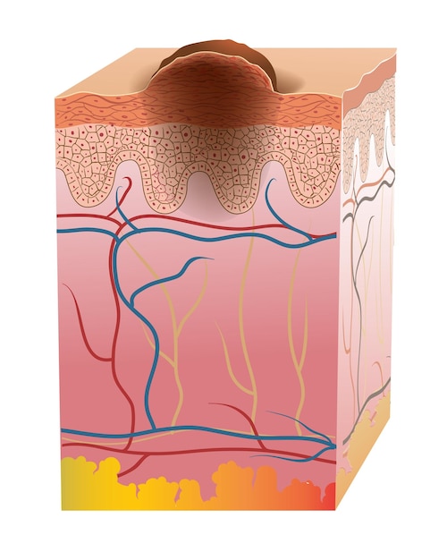 Illustration de la coupe transversale du cancer de la peau