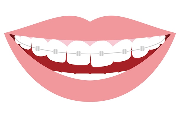 Illustration de la dentisterie esthétique et de l'orthodontie Disposition des dents déformée et support métallique