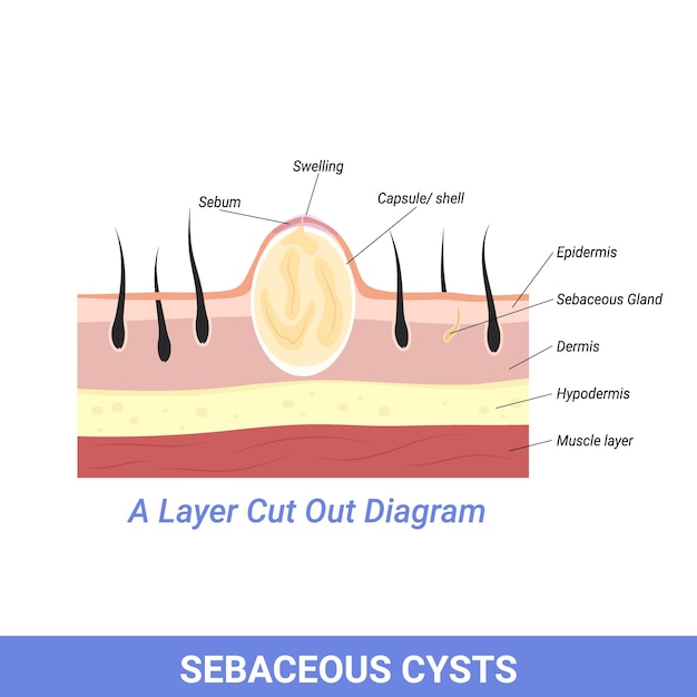 Vecteur illustration du kyste sébacé ou d'autres problèmes de peau et de follicule