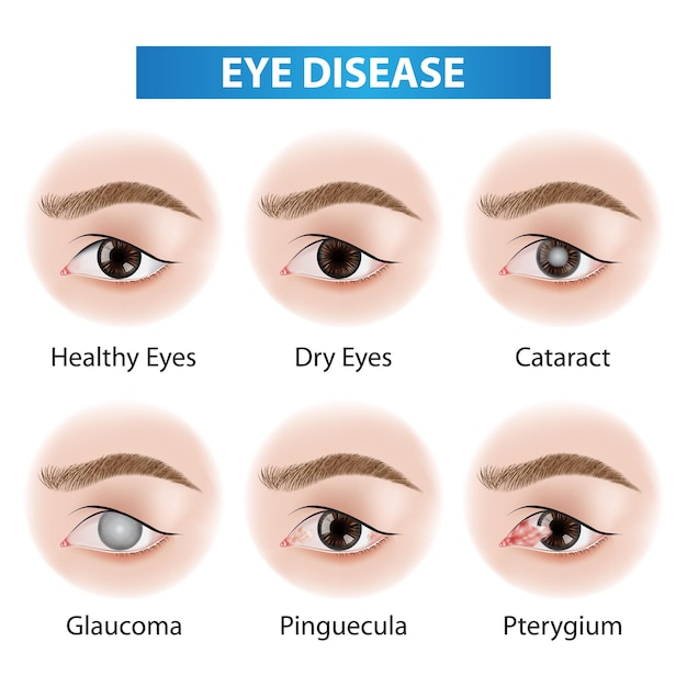 Illustration du vecteur problématique des maladies oculaires