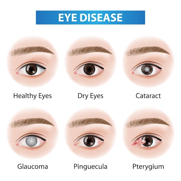 Illustration du vecteur problématique des maladies oculaires