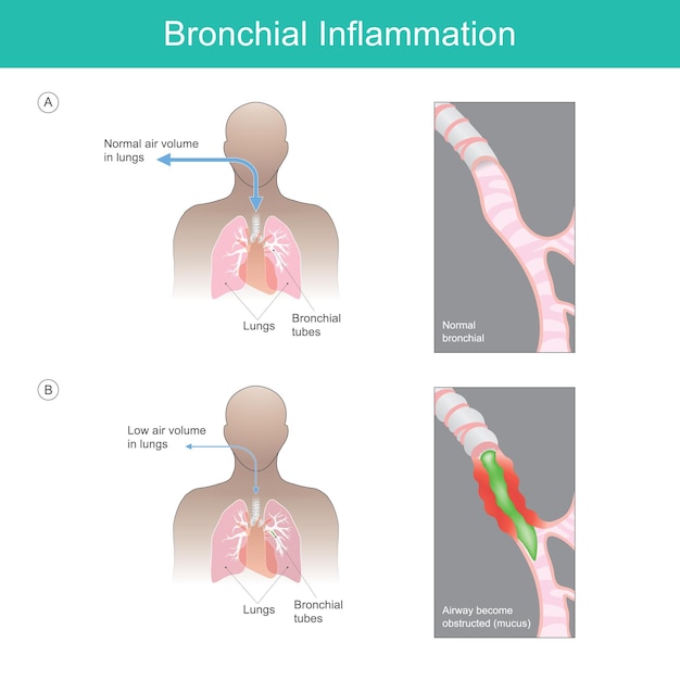 L'illustration De L'inflammation Bronchique Explique L'inflammation Bronchique Causée Par Un Virus, Une Bactérie Ou Des Particules Irritantes Qui Déclenchent Une Inflammation Et Ont Du Mucusxa