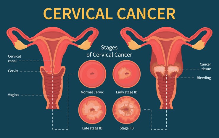 Vecteur illustration infographique du cancer du col utérin