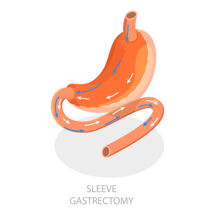 Vecteur d illustration isométrique à vecteur plat des types d'articles de gastrectomie à manches de chirurgie bariatrique