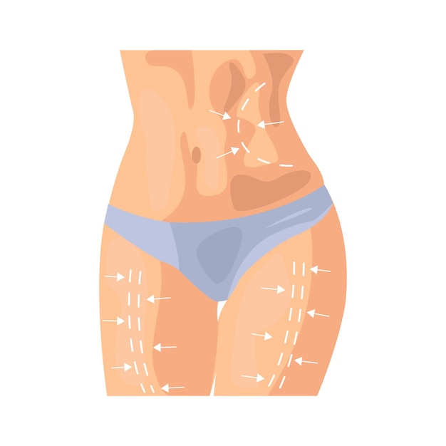 Illustration de liposuccion en style cartoon couleur modifiable