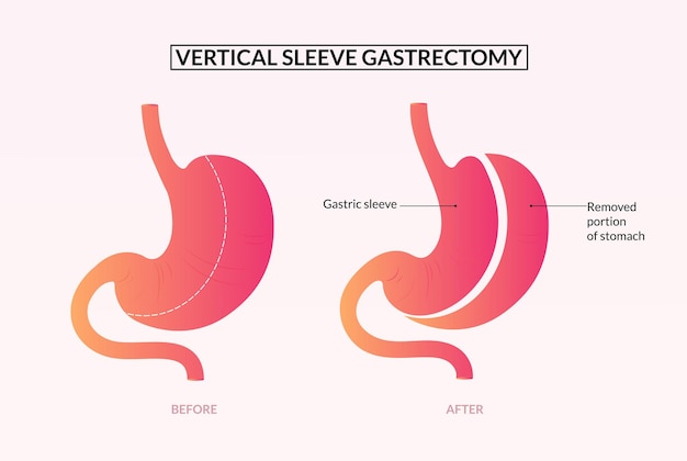 Illustration Médicale De Chirurgie De Gastrectomie à Manchon Vertical