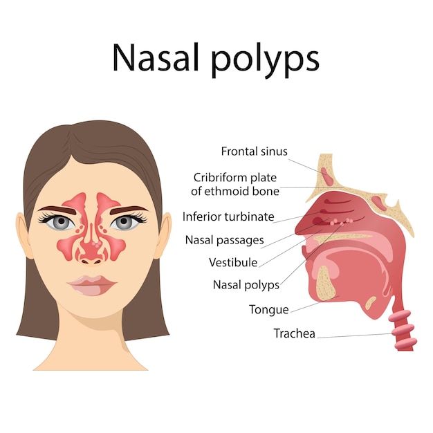 Vecteur illustration médicale vectorielle des polypes nasaux néoplasmes non cancéreux sur la muqueuse nasale ou les sinus