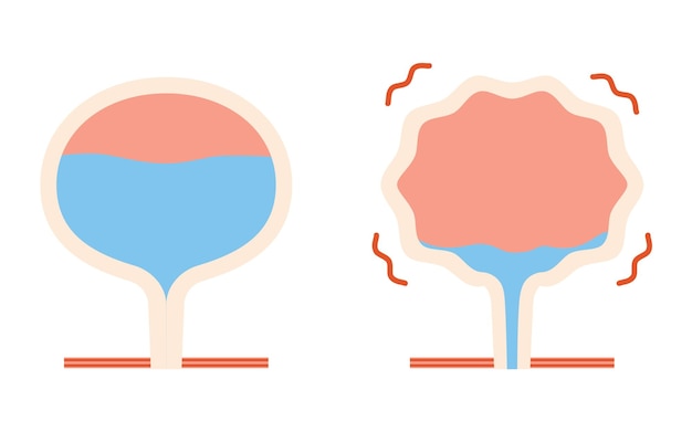 Vecteur illustration médicale de la vessie hyperactive par rapport à la vessie normale