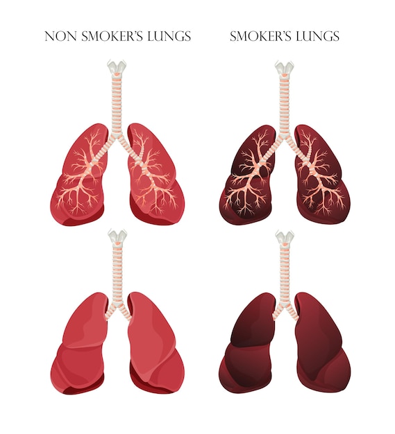 Illustration Des Poumons Sains Normaux Et Des Poumons Fumeur Concept D'arrêter De Fumer Illustration Vectorielle