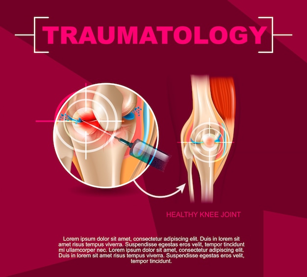 Vecteur illustration réaliste médecine de traumatologie en 3d