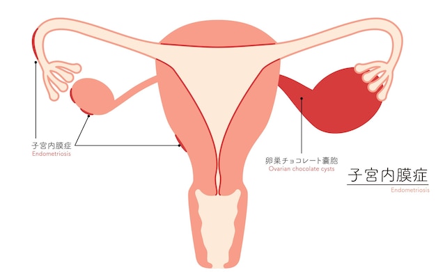 Vecteur illustration schématique de l'anatomie de l'endométriose de l'utérus et des ovaires