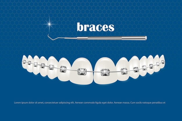 Illustration vectorielle 3d dents réalistes avec accolades Alignement de la morsure des dents dentition avec accolades accolades dentaires