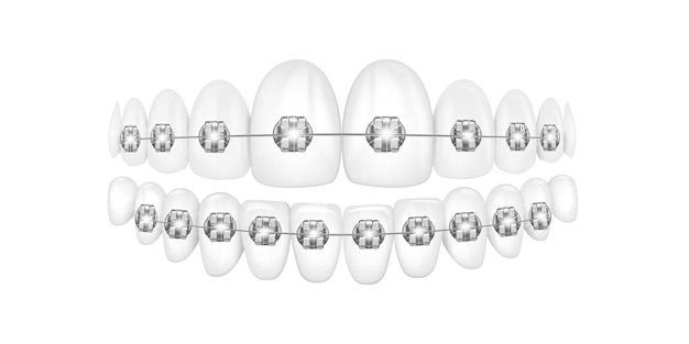 Vecteur illustration vectorielle 3d des dents réalistes avec des appareils dentaires alignement de la morsure des dents dentition