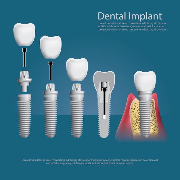 Illustration vectorielle de dents humaines et implant dentaire