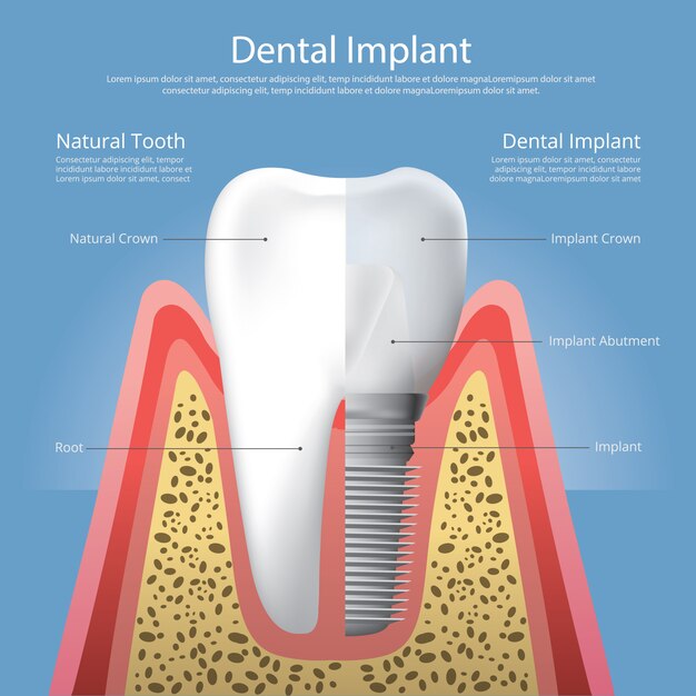 Illustration Vectorielle De Dents Humaines Et Implant Dentaire