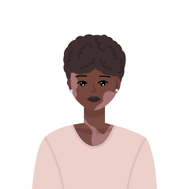 Illustration Vectorielle De Jeune Et Belle Femme Noire Avec Trouble Cutané Vitiligo