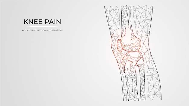 Illustration Vectorielle Polygonale De Douleur, Inflammation Ou Blessure Dans La Vue Latérale Du Genou. Anatomie Des Os De La Jambe Humaine.