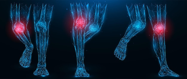 Illustration vectorielle polygonale de la maladie inflammatoire des jambes humaines de l'articulation du genou