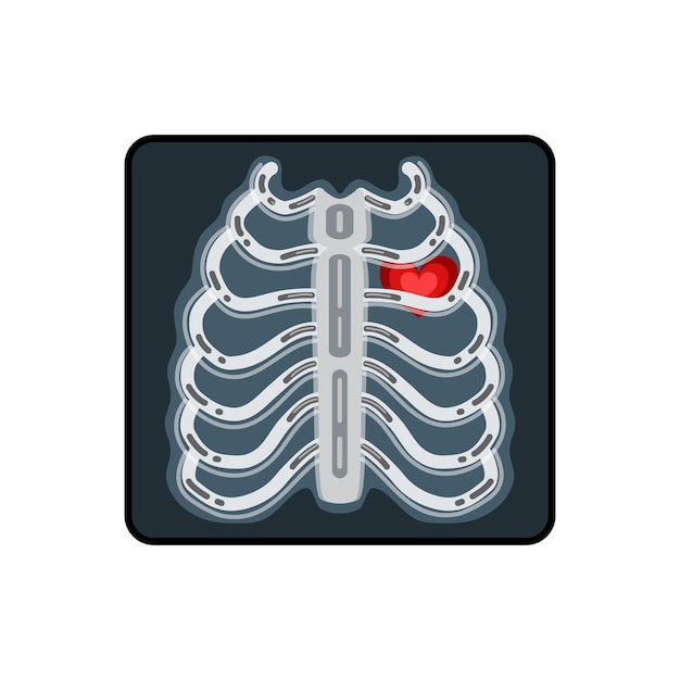 Illustration Vectorielle De Rayons X. Radiographie D'un Sein Humain Avec Un Coeur Rouge.