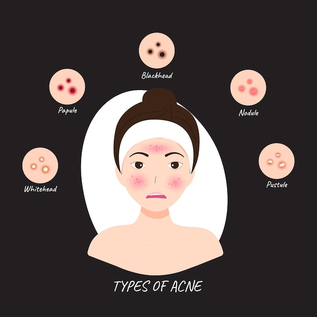 Vecteur illustrations les types d'acné surviennent sur un visage de femme